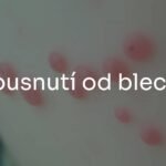 Close-up of flea bites on human skin, red itchy bumps in a row, realistic and detailed.