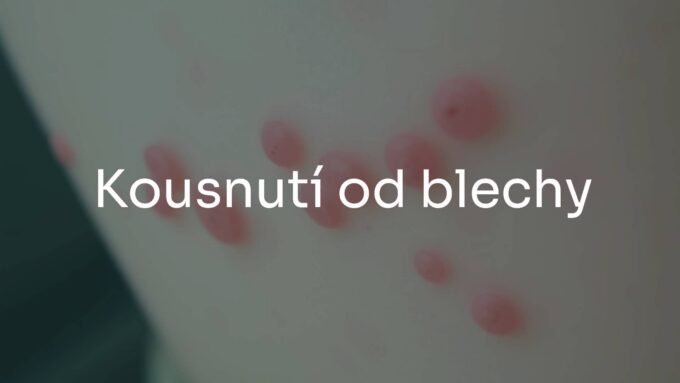 Close-up of flea bites on human skin, red itchy bumps in a row, realistic and detailed.